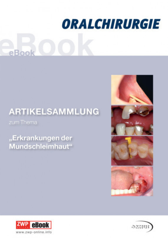 eBook Erkrankung der Mundschleimhaut Mundschleimhaut/2015