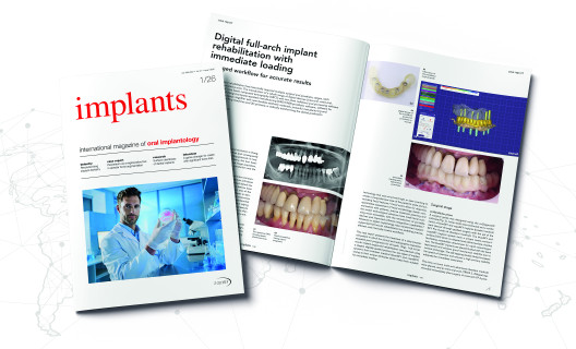Implants 03/2024 | OEMUS MEDIA