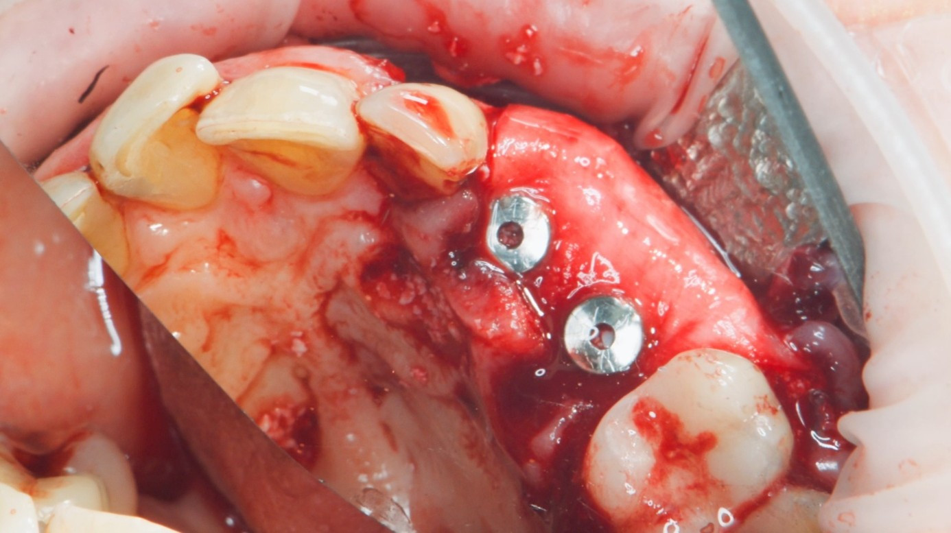 Immediate implant placement with simultaneous GBR in a complex patient