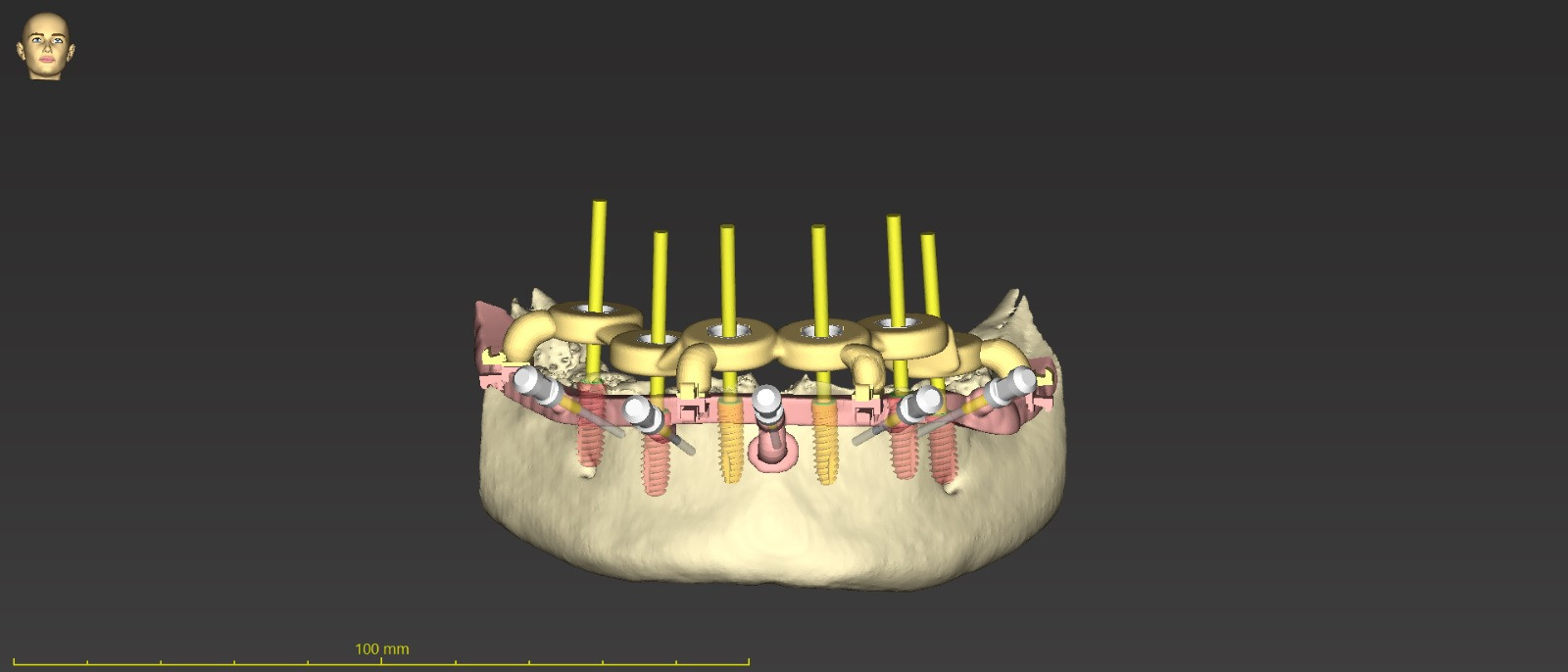 Fully guided full-arch implant rehabilitation with Immediate prefabricated PMMA provisionalisation by “Instant Screwing”