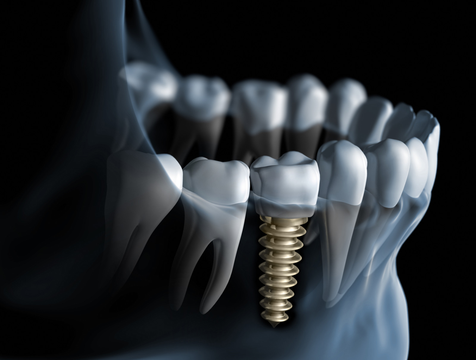 Peri-implantitis: the ongoing challenge in implant care
